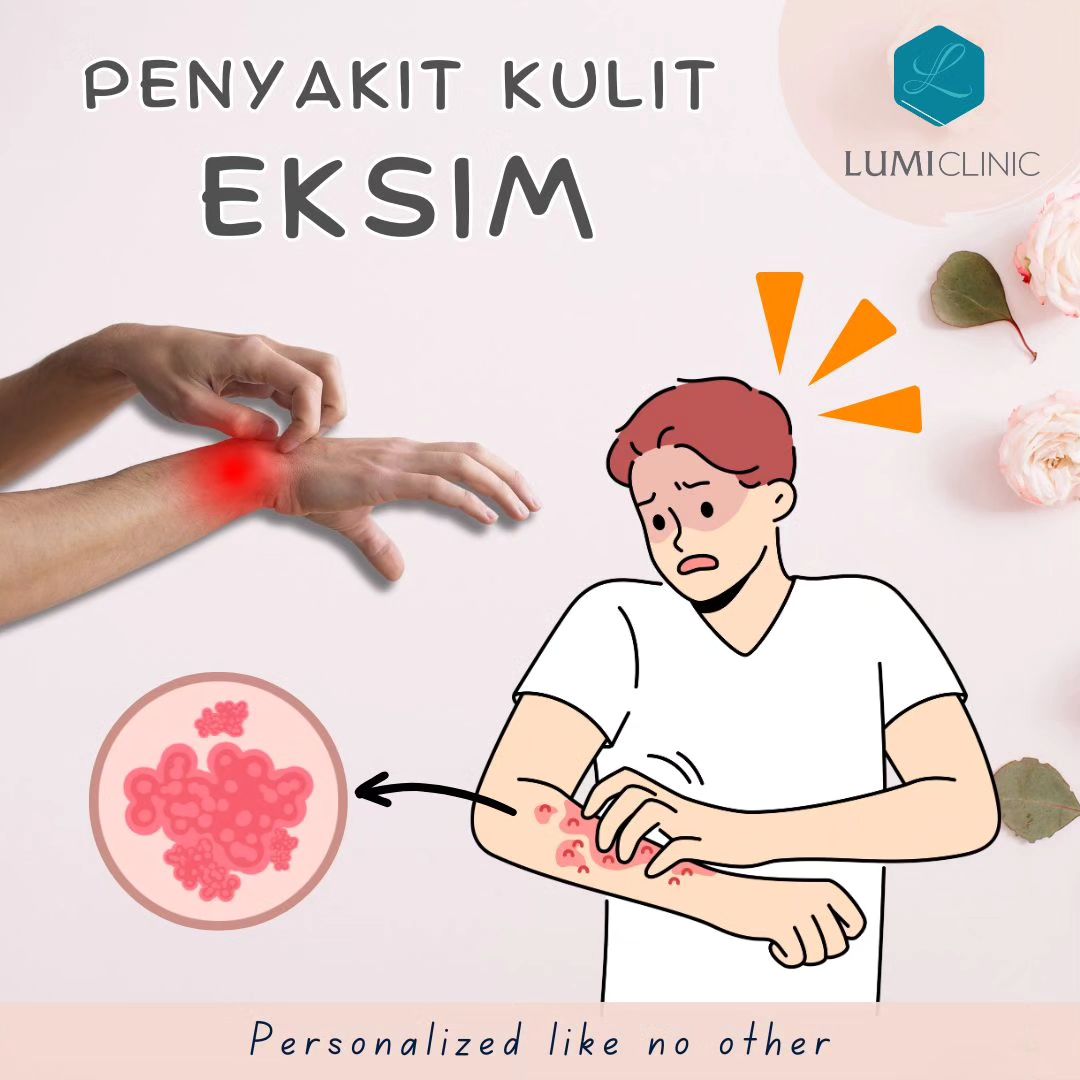 Eksim-eczema.jpg