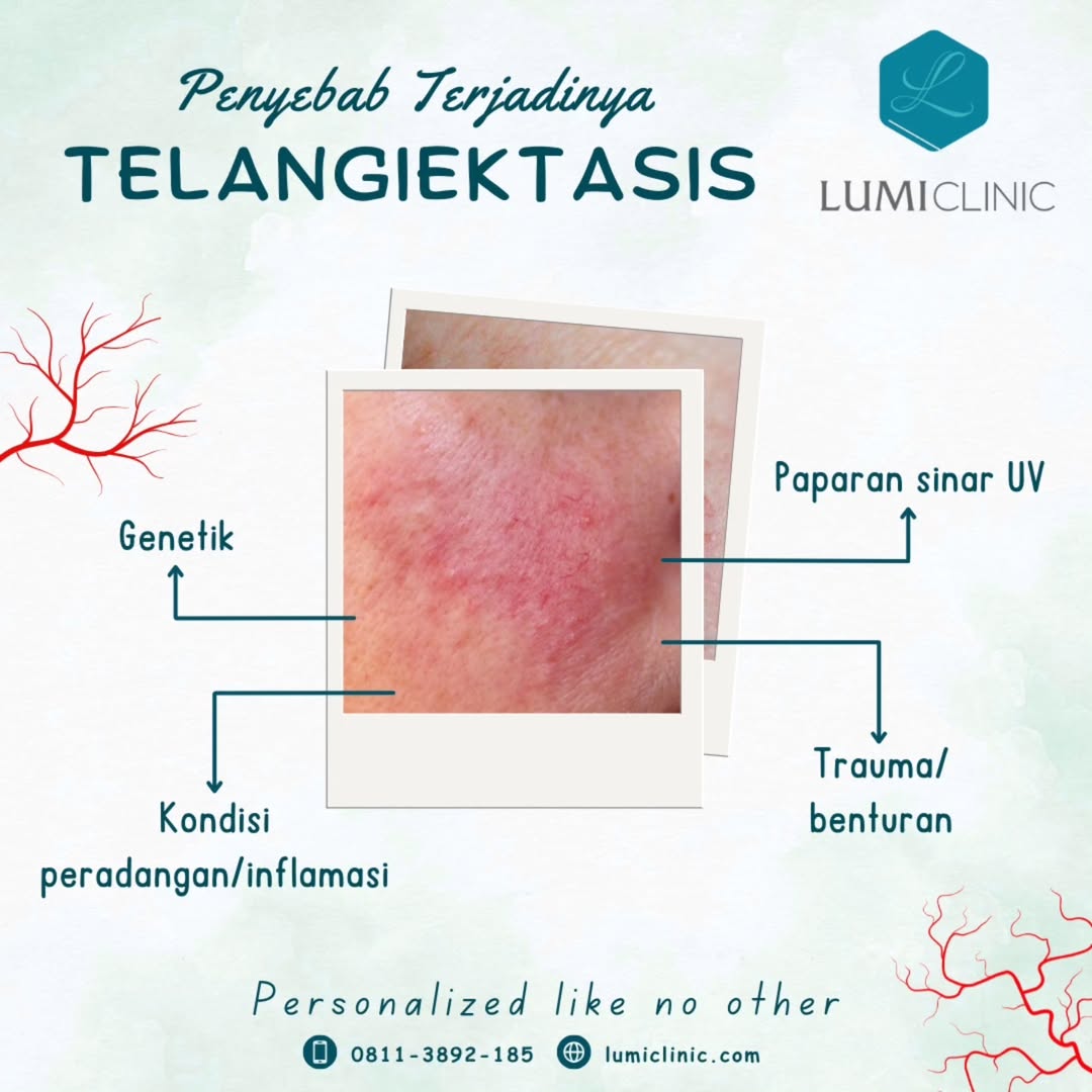 Telangiectasi.jpg